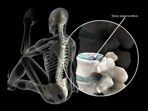 Ultrasound guided caudal epidural steroid injection