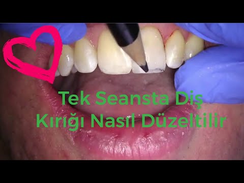 Yamuk Disler Nasil Duzeltilir Invisalign Yontemi Nedir Sante Bien Etre Sante Bien Etre
