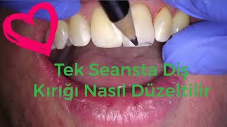 Disciye Gitmeyin Dis Curuklerini Agri Cekmeden Ortadan Kaldirin Sadece 5 Adimda Youtube