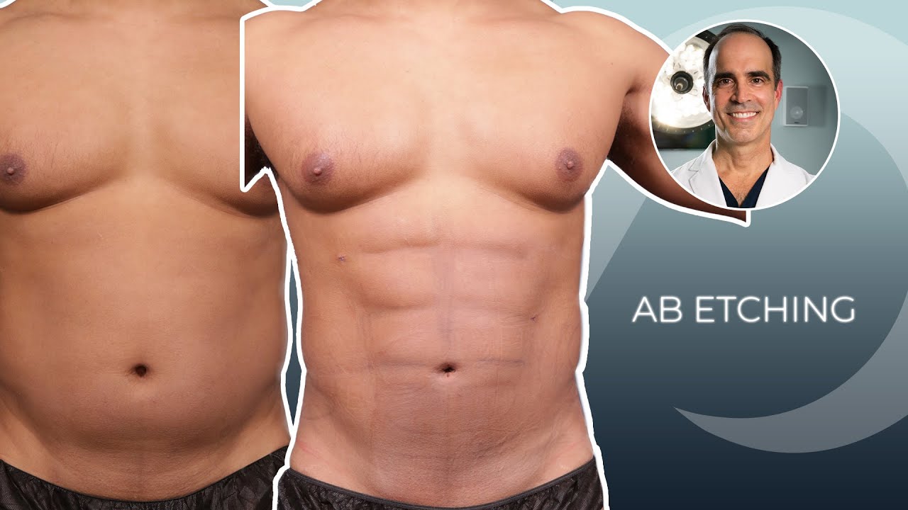 Male Body Sculpting Using Lipo BEFORE And AFTER YouTube Male Body Sculpting Using Lipo BEFORE And AFTER YouTube