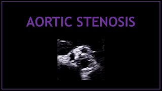 Aortic Stenosis (Echocardiography / Cardiology)