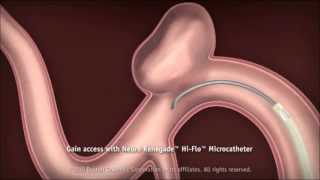 NEUROFORM EZ SYSTEM : PROCEDURAL STEPS