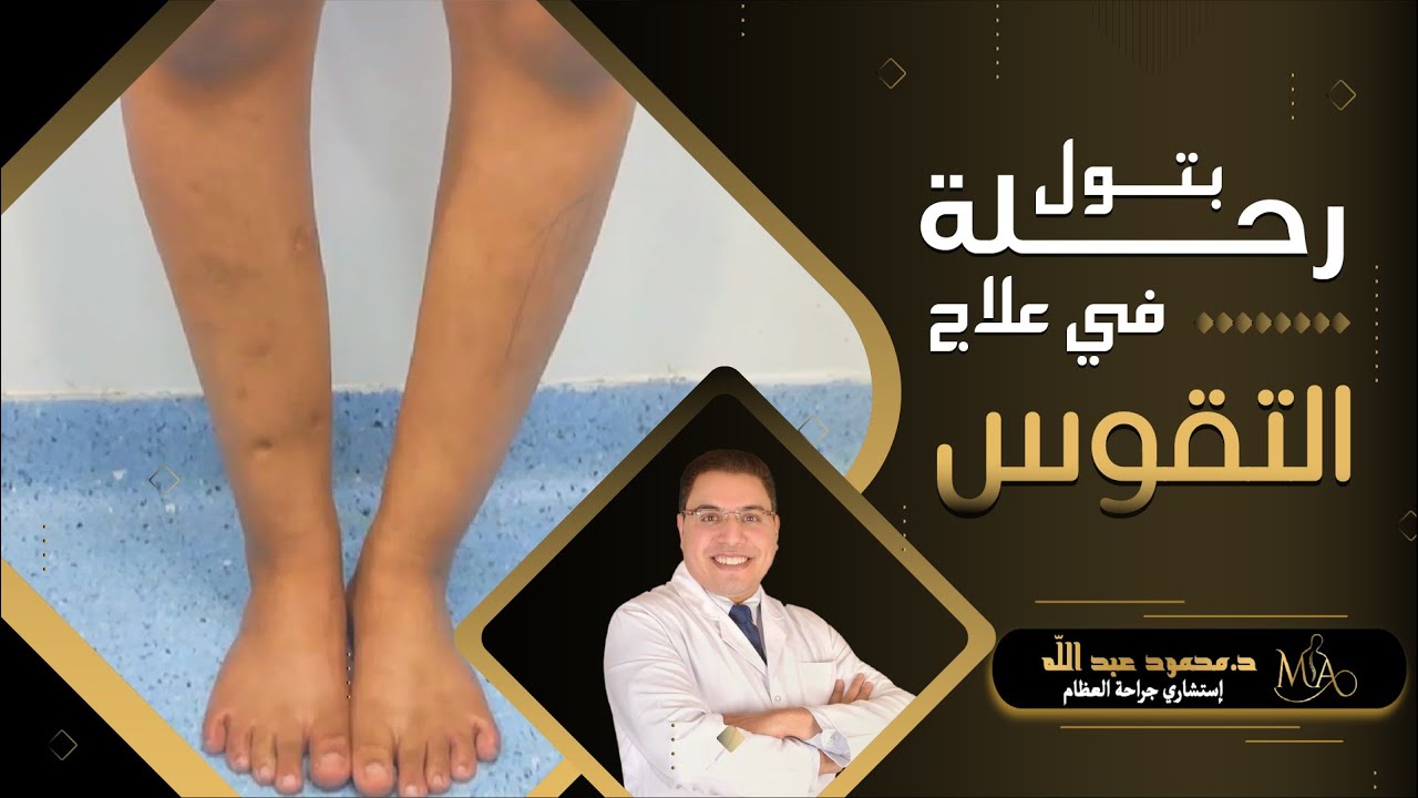 رحلة بتول مع تقوس الساقين مع دكتور محمود عبدالله