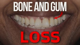 Should I Get a Dental Implant or Bridge on My Front Teeth If I Have Bone Loss?