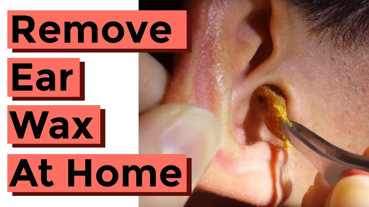 How do you remove ear wax blockage?