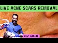 Live acne scar removal acnescars scarremoval fractionalco2laser