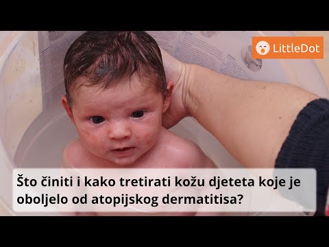Video: Šta Je Atopijski Dermatitis Kod Novorođenčadi?