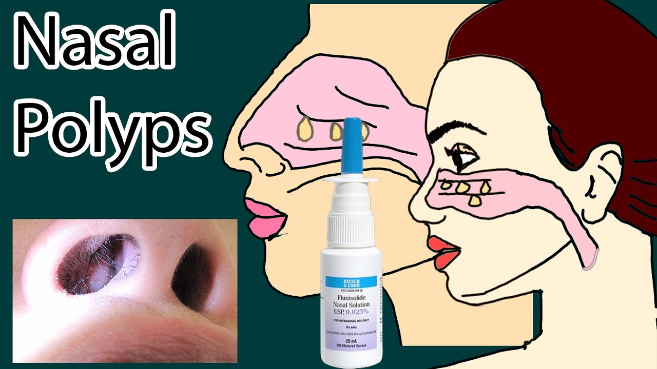 Nasal Polyps Symptoms Causes And Treatment Youtube