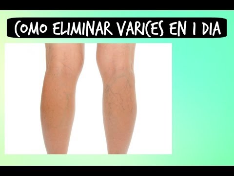 Como quitar las varices rapido