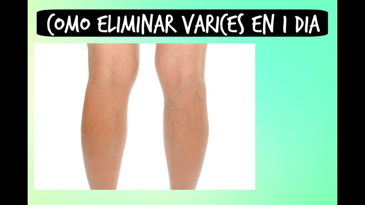 Como quitar las varices rapido