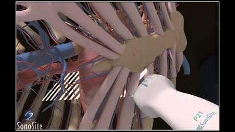 How To: Parasternal Long Axis View, Echocardiography 3D Video