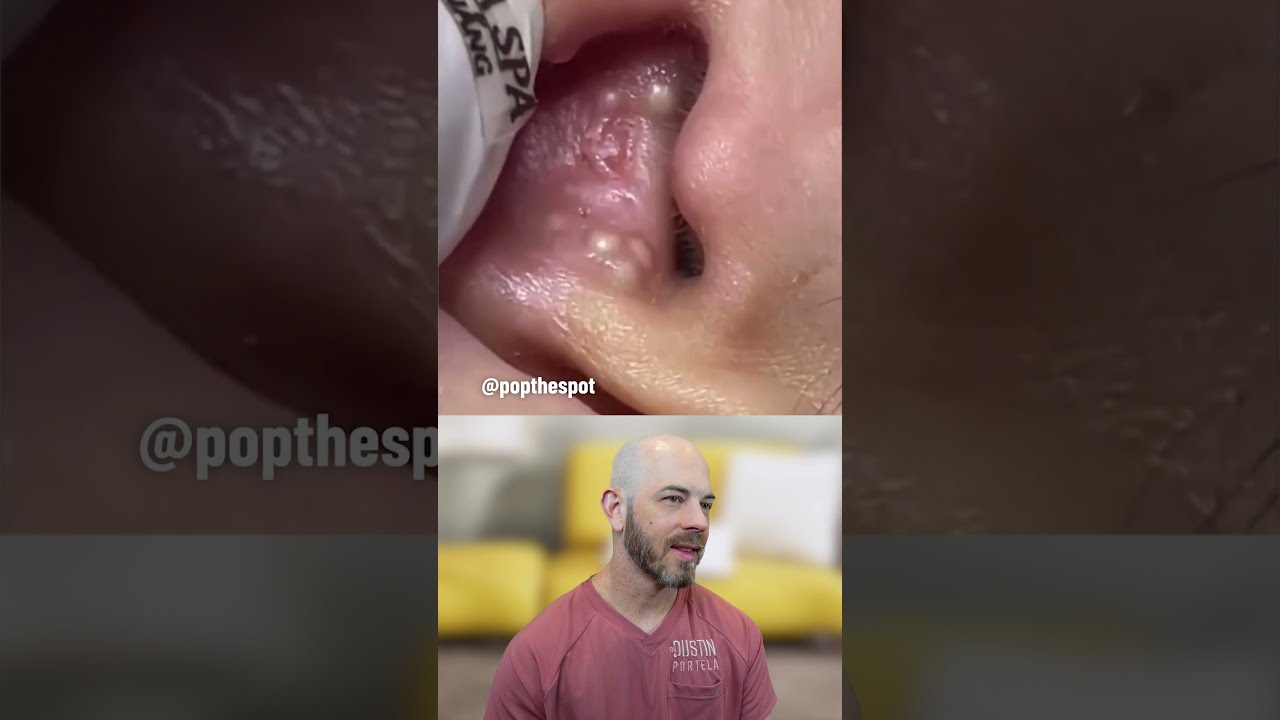 I Couldn T Believe This Cyst Video Was Real Credit Popthespot On TT Satisfying Skincare