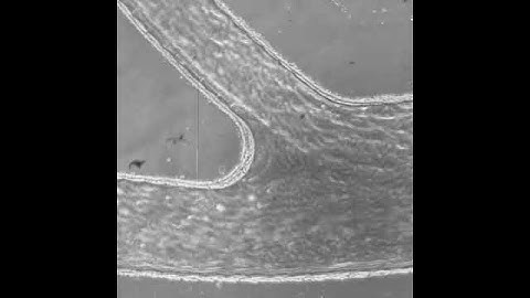 Slanted spiral microfluidics for the ultra-fast, label-free isolation of circulating tumor cells