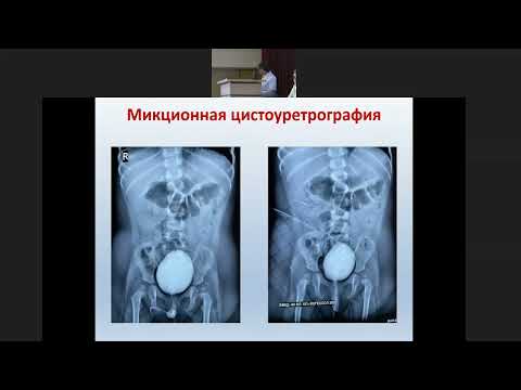 Хирургическая тактика при обструктивных уропатиях у детей