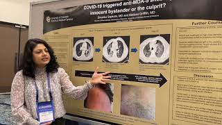 COVID-19 Triggered Anti-MDA-5 Antibody: Innocent Bystander or Culprit? Dr. Smarika Saptoka at RWCS22