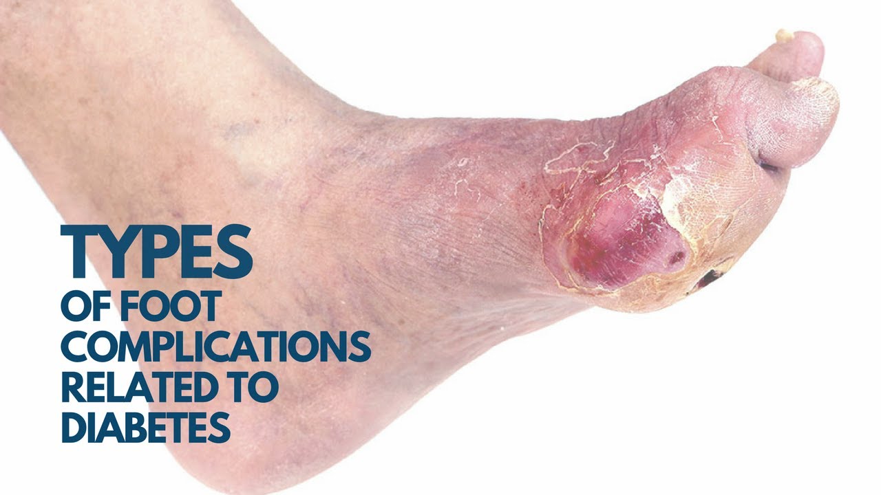Watch Bone Fractures: A Diabetes Complication Often Ignored video Watch Bone Fractures: A Diabetes Complication Often Ignored video
