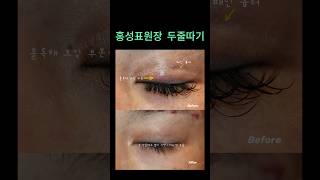 쌍꺼풀 줄이는 방법 두줄따기 #홍성표원장 #두줄따기 #눈성형 #쌍꺼풀재수술 #双眼皮修复 #