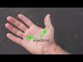Trigger Thumb and Ring Finger Injections 3 days post injections...