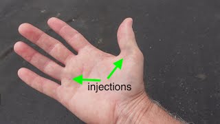 Trigger Thumb and Ring Finger Injections 3 days post injections...
