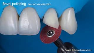 Educational video 'Direct restoration of frontal teeth' Part 2  Finishing & Polishing