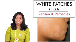 White Patches in Kids face – Reason, Care & Remedy