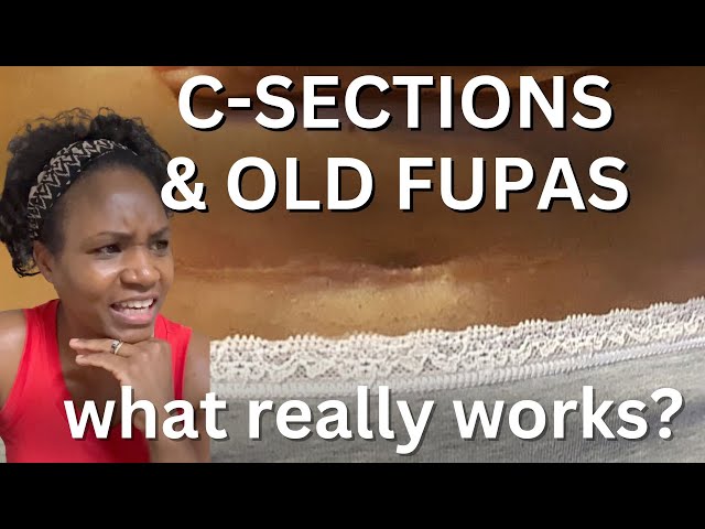 C-SECTION BELLY and OLD FUPAS. Does anything really work? 