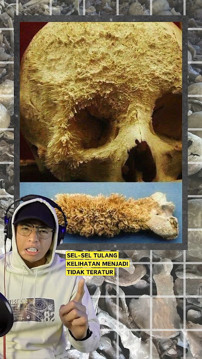 Kenapa KANSER TULANG Menakutkan?! 💀