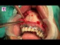 Fracture treatment  broken jaw