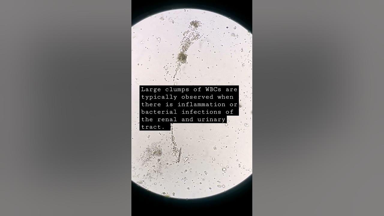 wbc-white-blood-cells-in-clumps-urine-mls-cls-microscope