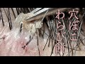 No.198 粘着かさぶたをやわりと剥がす / Gently removes sticky scabs from the scalp / 두피의 끈적끈적한 딱지를 부드럽게 제거합니다.