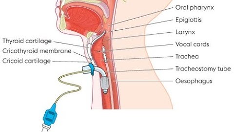 Tracheostomy CPT code - simplify medical coding