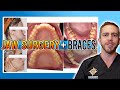 JAW SURGERY for A SEVERE UNDERBITE Correction!