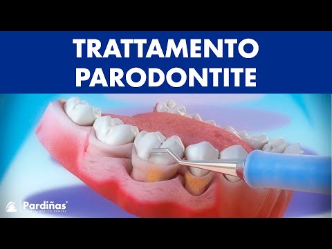 Video: Grafici Dentali E Parodontali: Scopo E Procedura