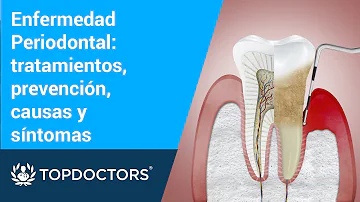 ¿Cuáles son los primeros síntomas de la enfermedad periodontal?