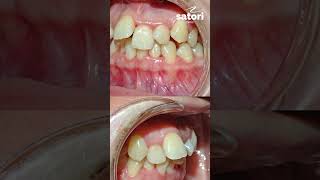 Фотопротокол перед началом ортодонтического лечения  #брекеты #зубы #стоматологиясамара