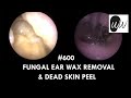 600 - Fungal Ear Wax Removal & Dead Skin Peel
