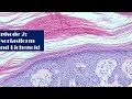 Episode 2 psoriasiform and lichenoid