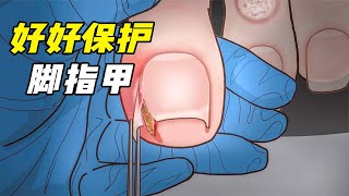 脚指甲微型手术，看完自己都有痛感，勿必要好好保护脚指甲！