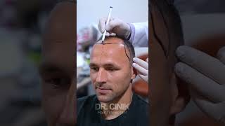 Dr Cinik Hair Transplant Gordon Schildenfeld