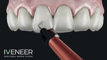 IVENEER - Injectable matrix system
