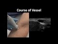 Ultrasoundguided peripheral vascular access  bavls