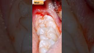 🦷Wisdom Tooth Extraction Without Forceps #wisdom #teethreplacement #teetshort #teethpain #wisdomteet