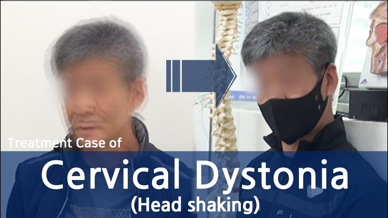 Dystonia Cervical Dystonia Spasmodic Torticollis 사경증 치료 근긴장이상증