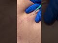 Spider vein removal at Amanda Azzopardi Aesthetics
