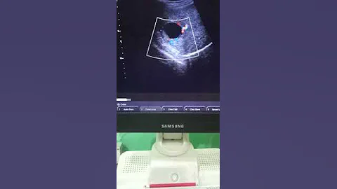 Ectopic  Pregnancy in Right lobe of Liver Rare
