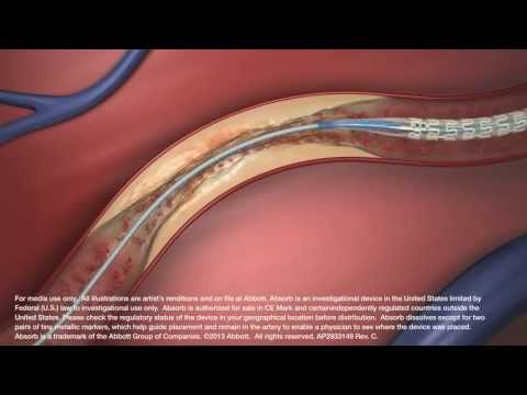 Abbott's Absorb Bioresorbable Vascular Scaffold