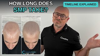 How Long Does Scalp Micropigmentation (SMP) Take | Treatment Timeline