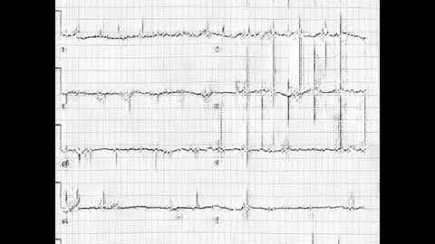 Генерация  ЭКГ-изображения при помощи генеративно-состязательной нейронной сети (GAN)