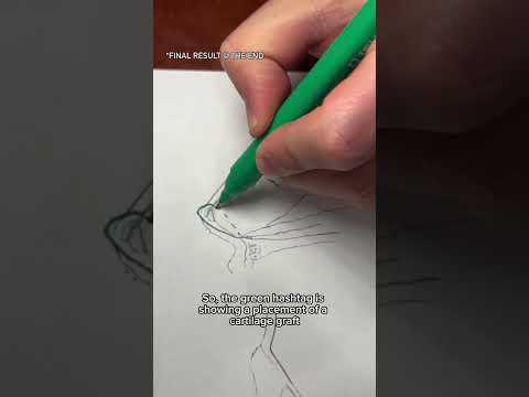 Video thumbnail: #rhinoplasty #rhinoplastyrecovery #rhinoplastyresults #plasticsurgery #plasticsurgeon