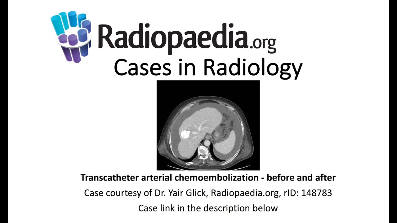 Transcatheter arterial chemoembolization - before and after (Radiopaedia.org) Cases in Radiology